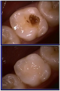 Composite Resin Fillings  